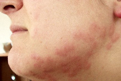 Rash From Bed Bug Bites