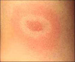 Lyme Disease - Bulls-Eye Rash